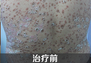 牛皮癣怎么治疗好