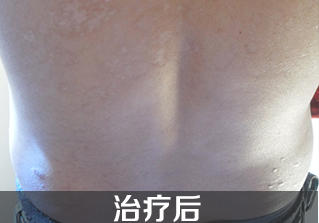 武汉治疗牛皮癣的医院
