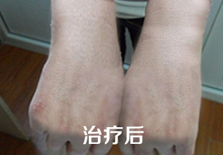 如何快速治疗牛皮癣
